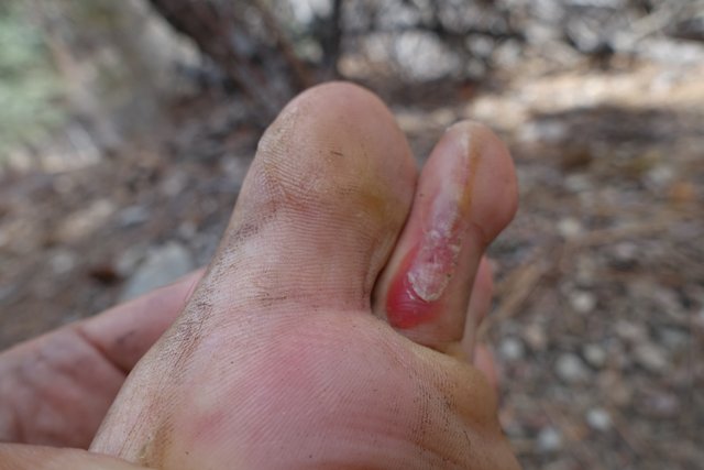 Blisters!  m256